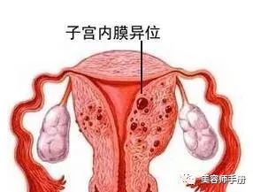 子宫内膜异位症：揭秘其成因、症状与治疗策略